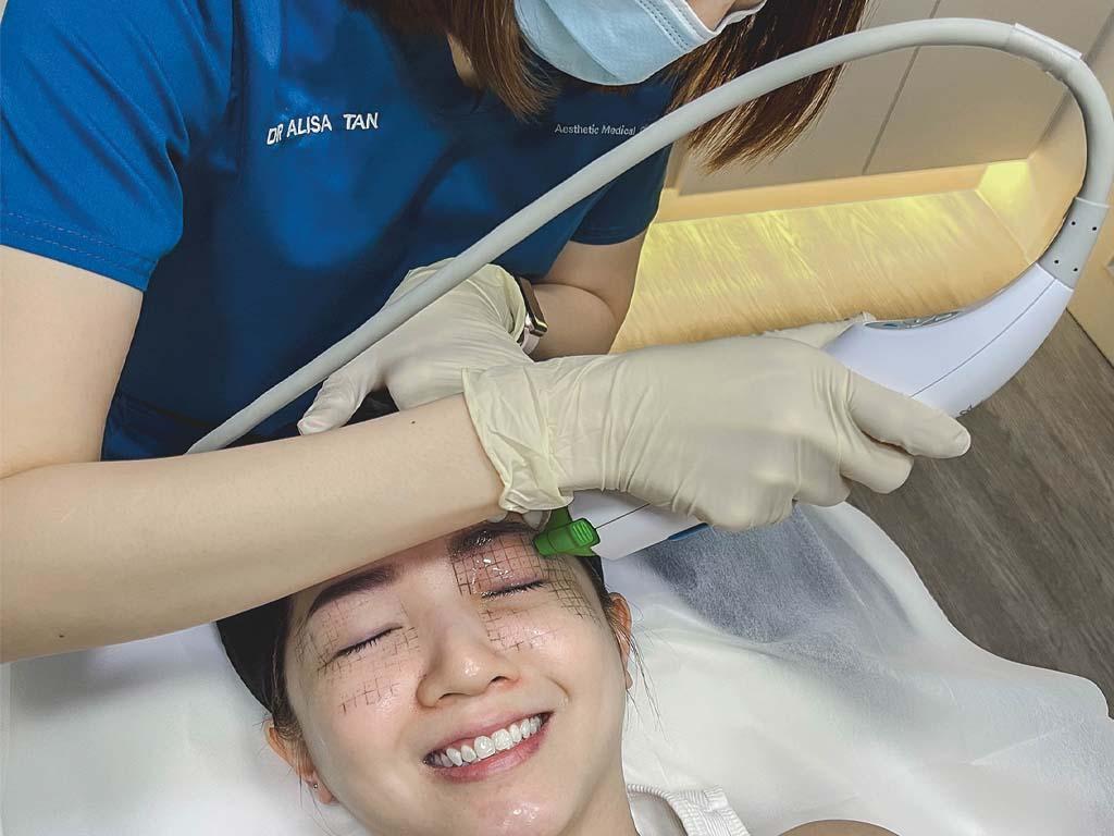 Thermage Eyelid  Tightening