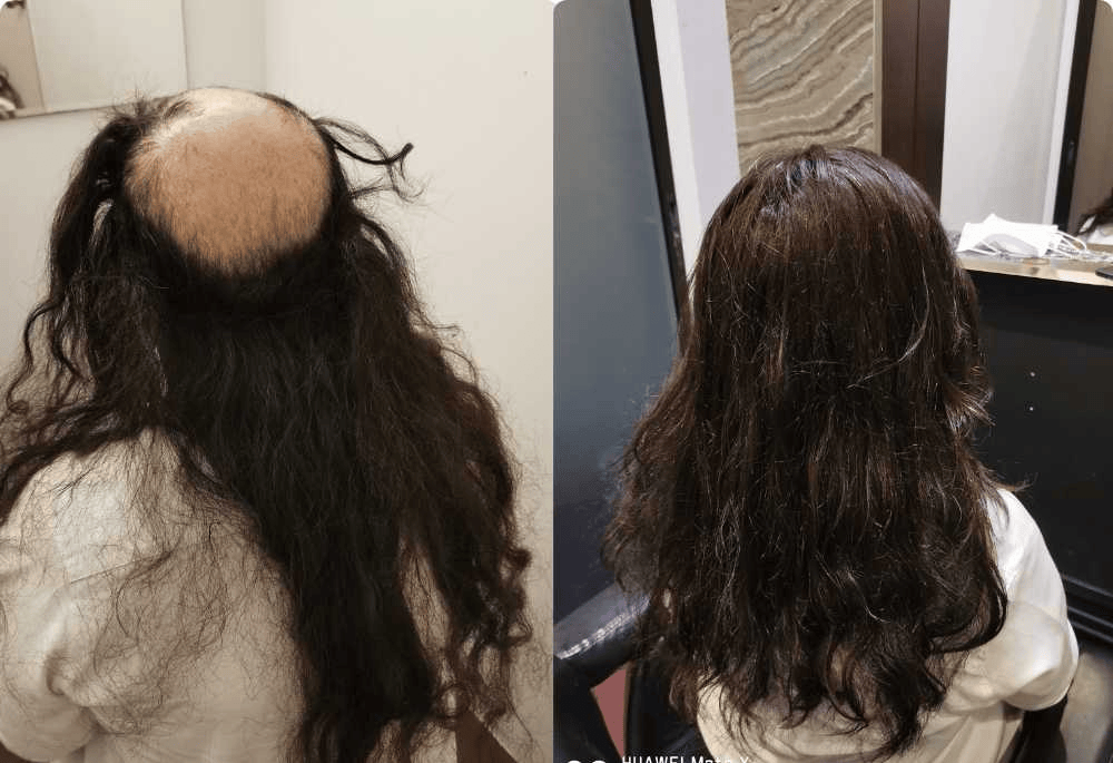 Hair  Replacement SG
