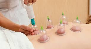 Cupping Therapy - Thumbay Hospital Ajman