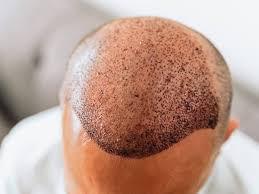 The Hair Transplant No One Will Know ...